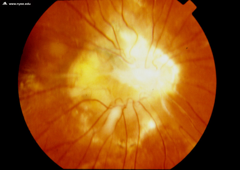 Combined Hamartoma of the Retina and RPE NYEE